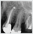 Image root canal xray